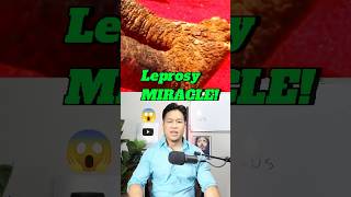 Leprosy Healing MIRACLE 😱 prayer supernatural [upl. by Llenoj]