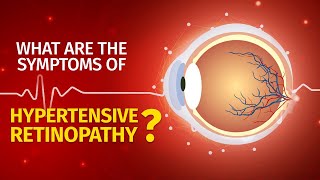 What are the symptoms of Hypertensive Retinopathy  Causes  Prevention [upl. by Killarney]