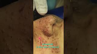 Facial Angiofibromas Removal with CO2 Laser [upl. by Letney200]