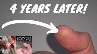 4 Years Later after slicing my finger open [upl. by Edison658]