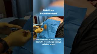 5 Gallons Drained From Abdomen  40lbs of Fluid shorts [upl. by Erret960]