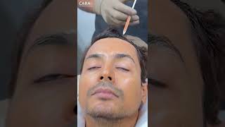 Trichometric PRP Hair Treatment to Deal With Hair Loss [upl. by Jensen]