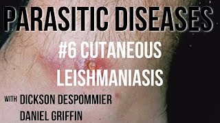 Parasitic Diseases Lectures 6 Cutaneous Leishmaniasis [upl. by Tegdig]