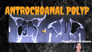 142What is antrochoanal polyp killian polyp surgeryeducation nose medicaleducation [upl. by Tamar279]