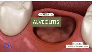 Alveolitis  qué es síntomas y tratamiento [upl. by Sheridan]