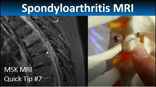 MRI in Axial Spondylarthritis Thoracic Spine Inflammation MSK MRI Quick Tip [upl. by Trebo33]