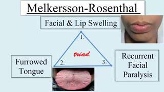 Melkersson Rosenthal Syndrome [upl. by Yank759]