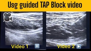 TAP BLOCK Ultrasound Video How to correctly find the correct plane  nervepainrelief [upl. by Ula]