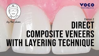 Direct Composite Veneers with 2 Layers Technique using AMARIS  Operative Dentistry  VOCO GmbH [upl. by Mad414]