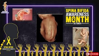 SFM Spina Bifida Awareness Webinar [upl. by Ute705]