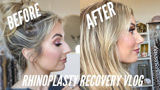 RHINOPLASTY RECOVERY EXPERIENCE [upl. by Yekim]