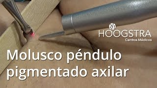 Molusco péndulo pigmentado axilar  Láser FireXel 16016 [upl. by Cirdor]