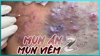 Big Cystic Acne Blackheads Extraction Blackheads amp Milia Whiteheads Removal Pimple Popping [upl. by Sonya]