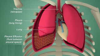 Pleural effusion  Internal medicine Etiology Clinical Features Diagnosis and Treatment Usmle [upl. by Aerdnac953]