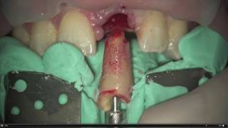 Dental Excellence 17 Root Extraction System [upl. by Jehius]