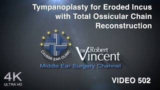 Tympanoplasty for Eroded Incus with Total Ossicular Chain Reconstruction [upl. by Eetse288]