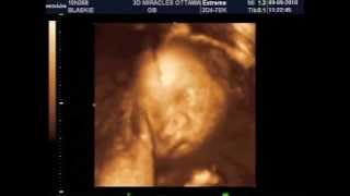 3D4D Ultrasound at 26 Weeks Pregnant Our Baby Girl [upl. by Dino]