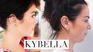 My Kybella Experience [upl. by Mungo107]