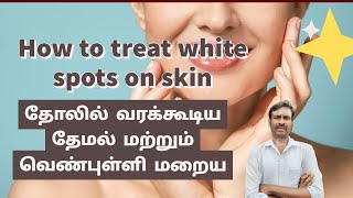 தோலில் வரக்கூடிய தேமல் மற்றும் வெண்புள்ளி மறைய  How to Treat White Spots on skin SHC [upl. by Zedecrem]