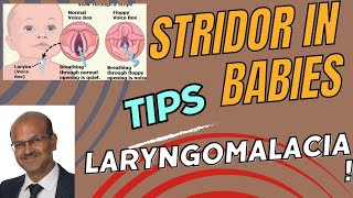 Approach to infants with stridor Laryngomalacia noisy breathing noisybreathing babybreathing [upl. by Donella984]