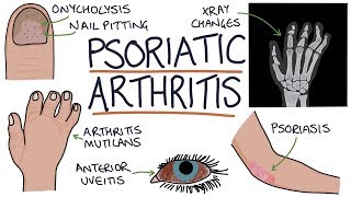 Psoriatic Arthritis [upl. by Alyehs]