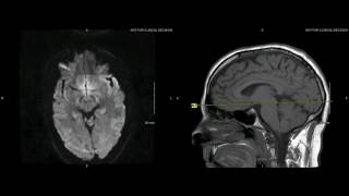 Unremarkable NonContrast Brain MRI Axial DWI Coefficient b1000 Example 1 [upl. by Hackney21]