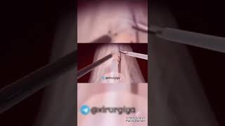 Thyroidectomy 283 jon7th [upl. by Lig]