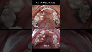 The most crowded teeth ive ever seen braces orthodontist dentist [upl. by Giana644]