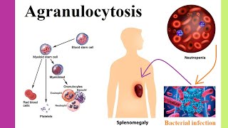 agranulocytosis [upl. by Atenik666]