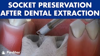 Tooth extraction  Treatment for socket preservation © [upl. by Ahsenra]