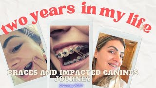 2 YEAR WITH BRACES  Impacted Canine Journey How far Out My Teeth Are progressupdate [upl. by Lynelle344]