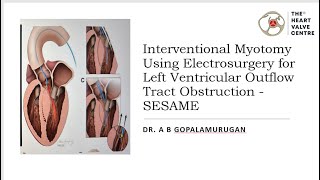 Interventional Myotomy Using Electrosurgery for Left Ventricular Outflow Tract Obstruction  SESAME [upl. by Malinde]