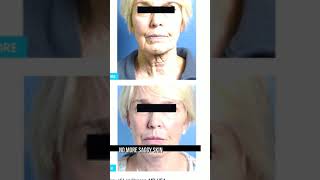 The Best Laser Treatment for Skin and Wrinkles [upl. by Amsa]