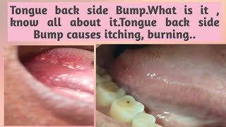 Tongue back side BumpWhat is it  know all about itTongue back side Bump causes itching burning [upl. by Tiram]