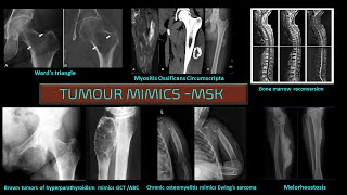 TUMOUR MIMICS  MSK [upl. by Dehlia]