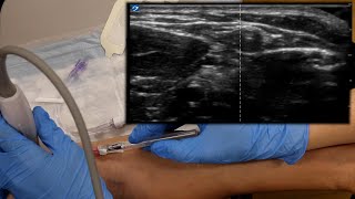 Ultrasound Guided IV Tutorial [upl. by Ecinrev]