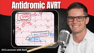 Antidromic AV Reentry Tachycardia AVRT EKG  ECG Lecture [upl. by Schilit313]