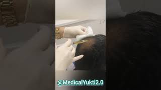 PRP Hair treatment LIVE 🧐🤔🧑‍⚕️2 [upl. by Wernsman]