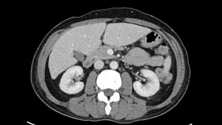 Anatomy of CT scans Abdomen [upl. by Asirb]