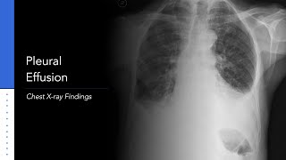 Pleural Effusion Explanation of Xray Findings [upl. by Einamrej]