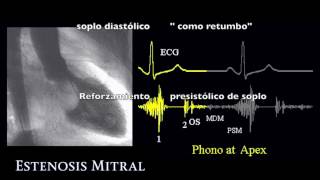 Auscultación de la Estenosis Mitral [upl. by Darin]