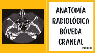 Anatomía Radiológica Bóveda craneal [upl. by Aitra353]