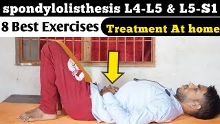 spondylolisthesis l5 s1 exercises spondylolisthesis l5 s1 grade 1 anterolisthesis l4 L5 treatment [upl. by Eidoc]