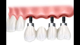 Diş çekimi sonrası implant ve köprü uygulaması [upl. by Jasun]