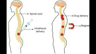 Intrathecal Route of Drug Administration  Uses Procedure Advantages Disadvantages [upl. by Daahsar]