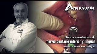 ►Daños eventuales al Nervio Dentario Inferior y lingual  Dr Rafael Ruíz Rodríguez [upl. by Eillor]