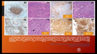 WHO updates Lymphoid neoplasms [upl. by Nylanej190]