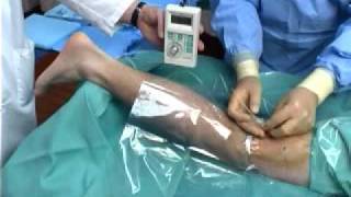 Continuous Popliteal Nerve Block [upl. by Dorcea]