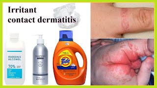 Contact Dermatitis Symptoms Treatment and Causes [upl. by Cordelie341]