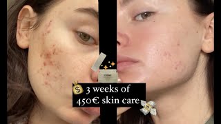 How 450 skincare routine cured 12 years of my acne suffering [upl. by Oivaf245]